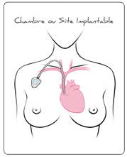 Chambre Implantable