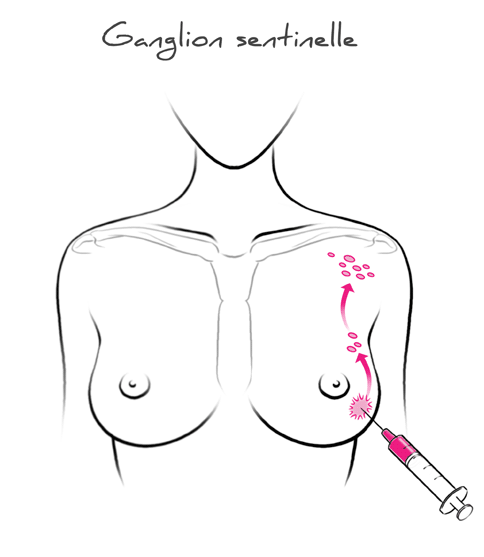 Curage axillaire et ganglion sentinelle - Dr Le Digabel