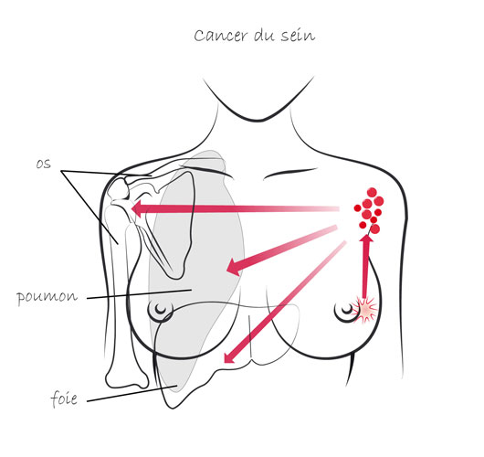 Cancer du sein : une tumeur identifiée lors de sa réduction mammaire