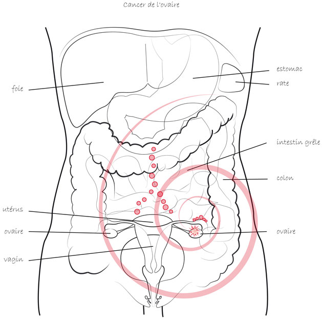 Cancer de l'ovaire - Dr Le Digabel
