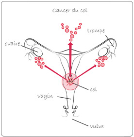 cancer du col de l'uterus