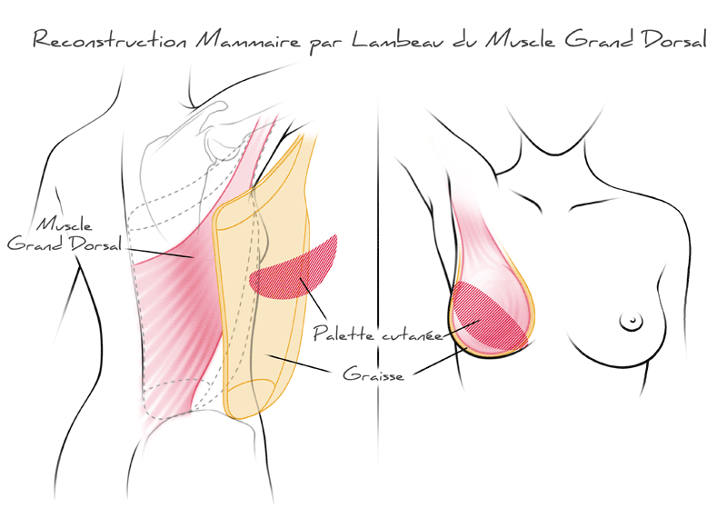 reconstruction mammaire